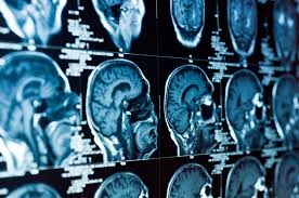 brain ct scan
