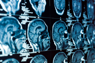 If you have suffered a traumatic brain injury due to the negligence of someone else, the Phoenix injury attorneys at Mushkatel, Robbins & Becker are here to help.