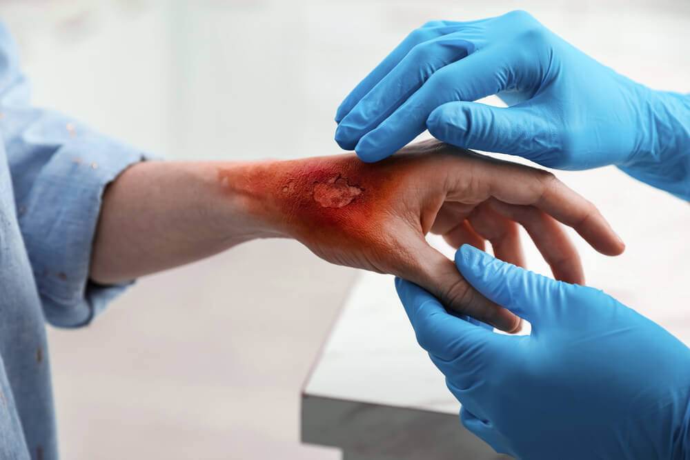 Doctor examining terrible patient's burn of hand.