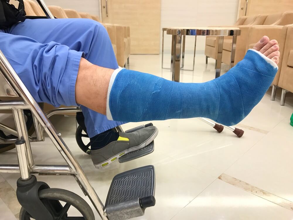 A man with cast around broken leg at hospital.